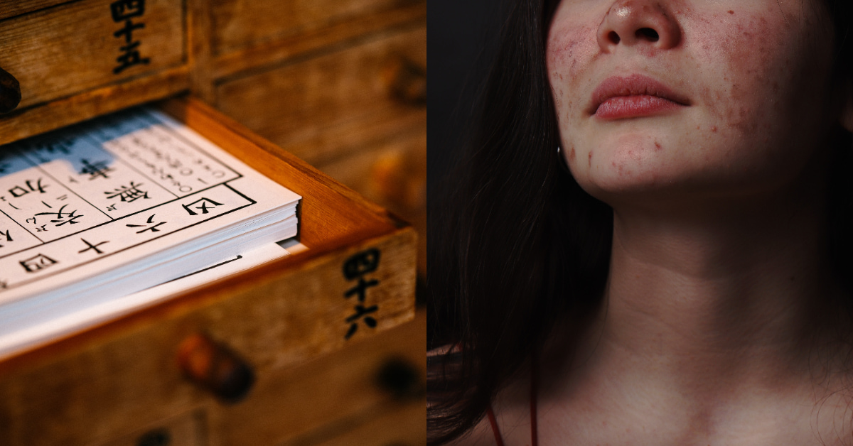 「痘痘位置」暗示五臟六腑健康狀態？額頭是疲勞導致「心火旺」，女性注意長「下巴」與內分泌有關